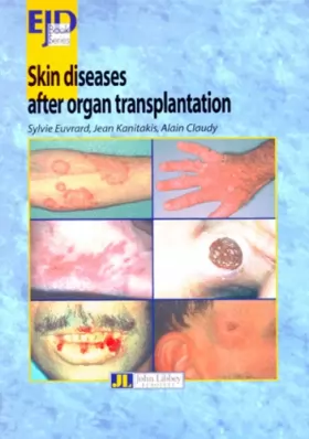 Couverture du produit · Skin diseases after organ transplatation