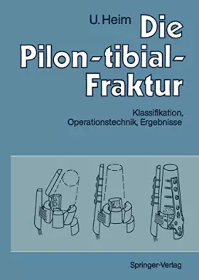 Couverture du produit · Die Pilon-tibial-Fraktur: Klassifikation, Operationstechnik, Ergebnisse