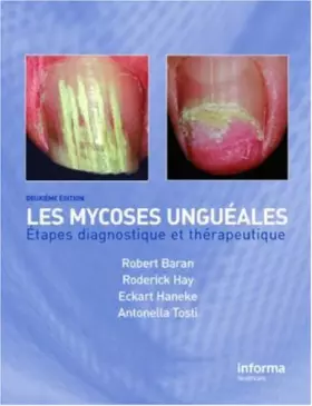 Couverture du produit · Onychomycosis/Les mycoses ungueales: Etapes diagnostique et clinique